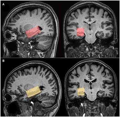 Altered glutamate–glutamine and amide proton transfer-weighted values in the hippocampus of patients with amnestic mild cognitive impairment: A novel combined imaging diagnostic marker